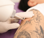 2 cusromized tratment plan