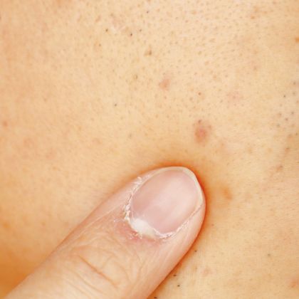 Acne marks mild scars