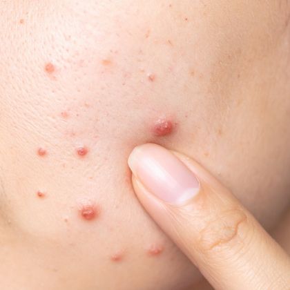 Active acne pimples