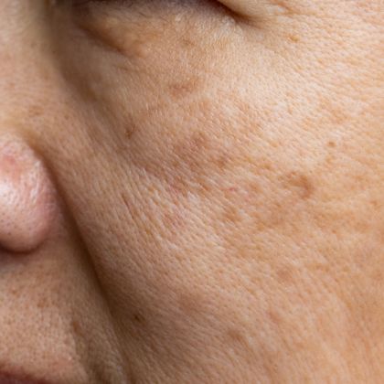 Dark spots sun damage