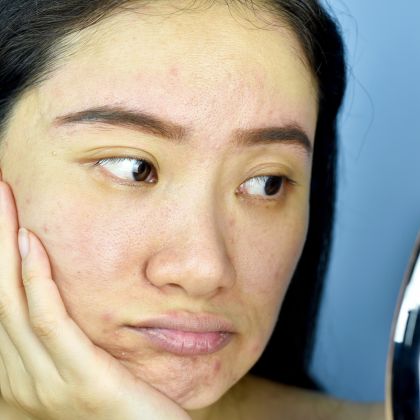 Dull tired looking skin 1