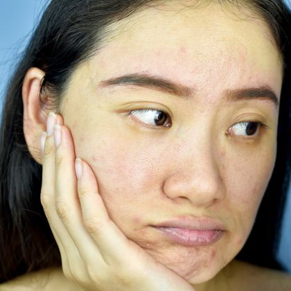 Dull tired looking skin 3