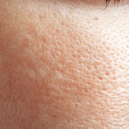 Enlarged Pores 1