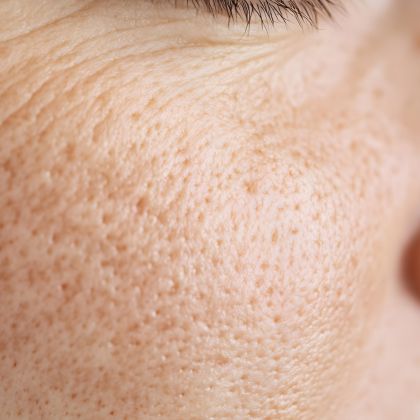 Enlarged pores 2