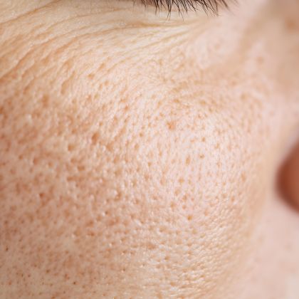 Enlarged pores 3