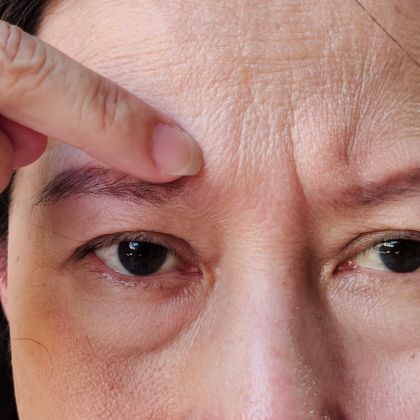 Fine lines wrinkles 2