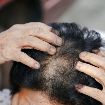 Hair fall thinning