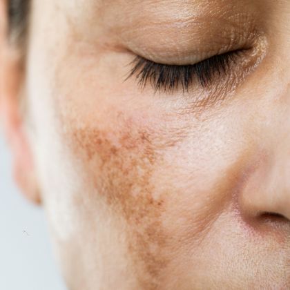 Hyperpigmentation 1