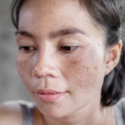 Hyperpigmentation