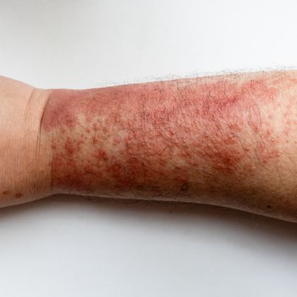 Inflammation redness