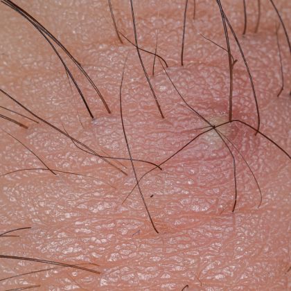 Ingrown hair issues