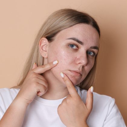 Oily acne prone skin