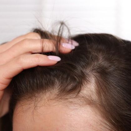 Patchy Hair Loss