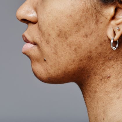 Pigmentation dark spots