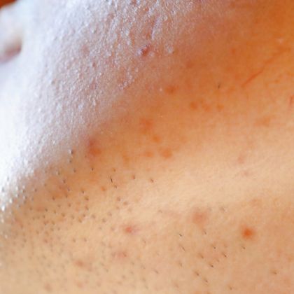 Post acne pigmentation