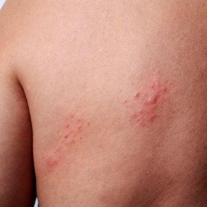 Raised or uneven skin lesions