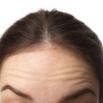 Reduced hair density
