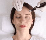 Step 4 Microneedling