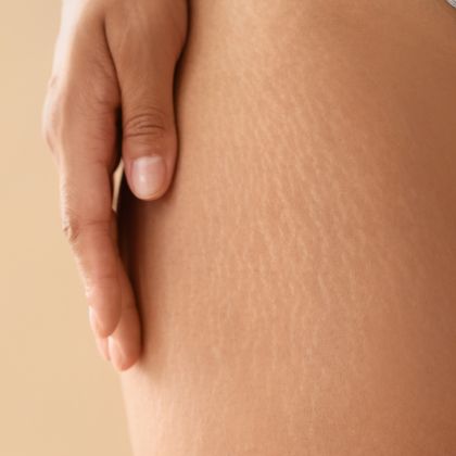 Stretch Marks