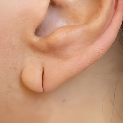 Torn or split earlobes