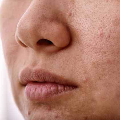 Whiteheads blackheads