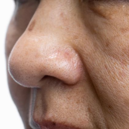 pigmentation dark sport 2