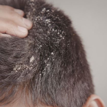 Dandruff Flakiness compressed
