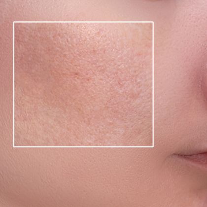 Enlarged Clogged Pores compressed