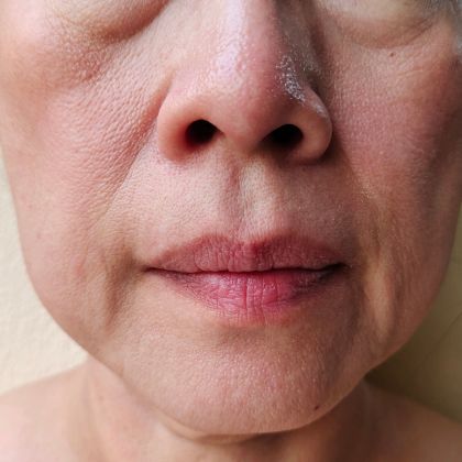 Fine Lines Early Aging