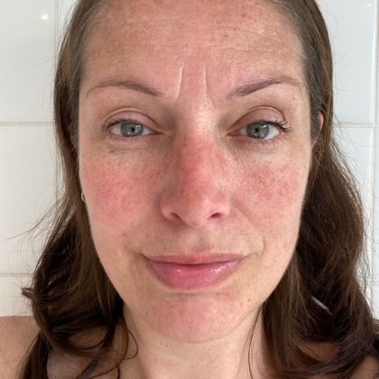 Pigmentation Sun Damage compressed