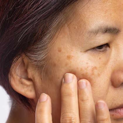 Pigmentation Sun Damage