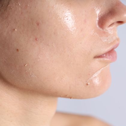 Uneven Skin Tone Texture compressed