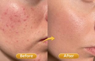 acne pimple treatments in Sion West Mumbai