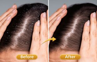 anti dandruff treatment in Sion West Mumbai