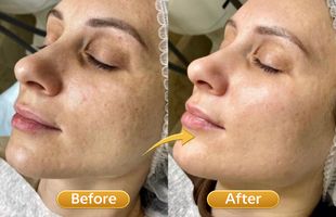 carbon facial in Sion West Mumbai