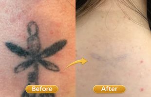 carbon facial tatto removel in Sion West Mumbai 1