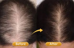 hair fall control in Sion West Mumbai