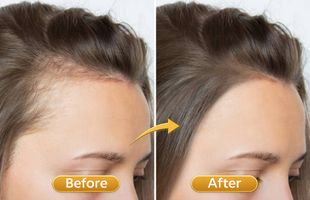 hair thinning baldness in Sion West Mumbai