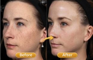 hydrafacial _ vampire facial