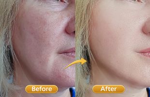 microneedling dermapen in Sion West Mumbai