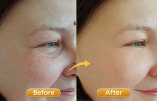 pigmentation melasma in Sion West Mumbai