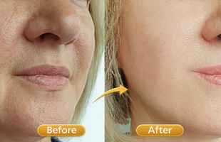 prp meso stem cell in Sion West Mumbai