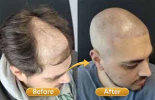 scalp micropigmentation in Sion West Mumbai