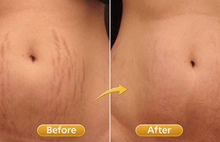 scar stretch mark reduction in Sion West Mumbai