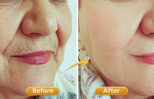 skin tightening in Sion West Mumbai