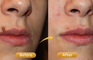 wart mole sking tag in Sion West Mumbai