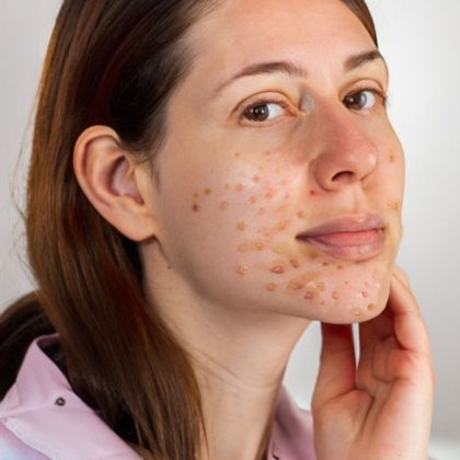 Laser for Acne Scars cc