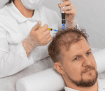 Mesotherapy for Hair Growth step 1
