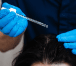 Mesotherapy for Hair Growth step 5
