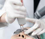 Step 3 Laser Application 1